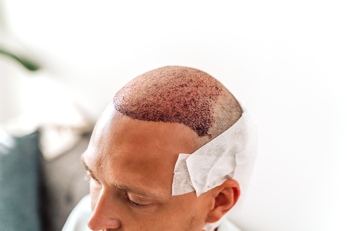 erreur greffes de cheveux