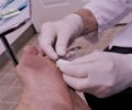 Infection du point de suture résorbable : Tout ce que vous devez savoir